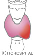 急性甲状腺炎