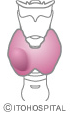 Thyroid tumors