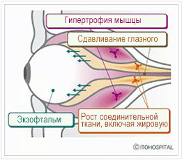 Эндокринная офтальмопатия